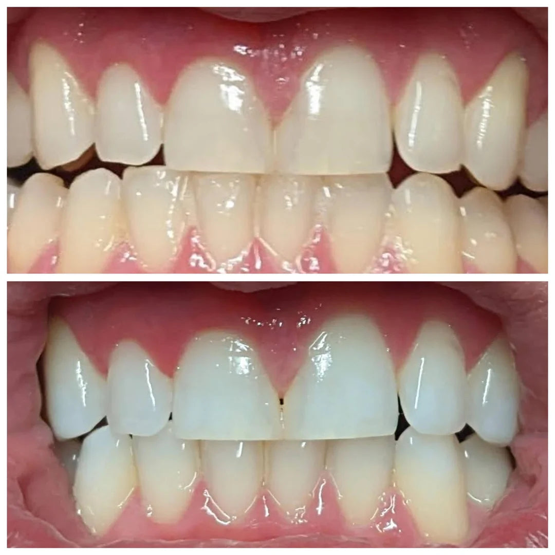 WHITE MAX 3D - Bandas ULTRA Blanqueadoras de Dientes